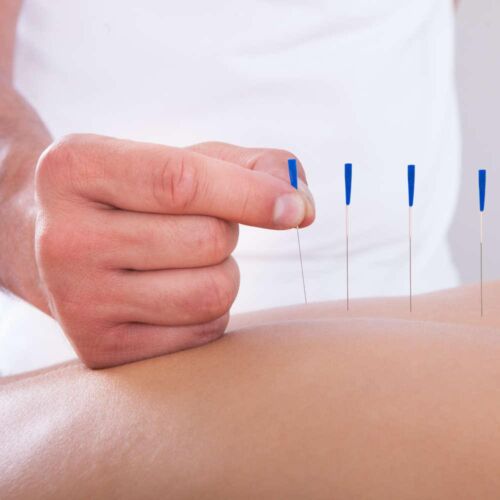 acupuncture needling